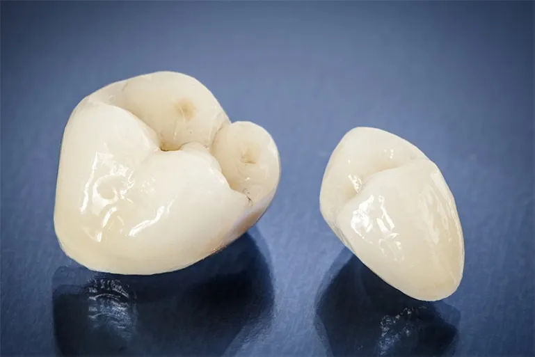 オールセラミッククラウン(1歯)